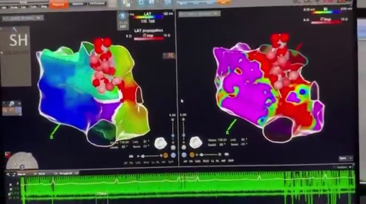 Corrigen especialistas del CMN “20 de Noviembre” del ISSSTE arritmias cardiacas