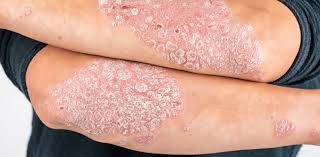 Llega a México nuevo tratamiento para psoriasis en placas y lanzan campaña para eliminar el estigma de la enfermedad