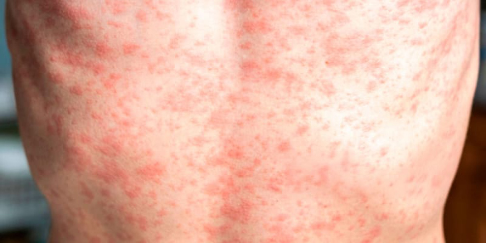 El sarampión se puede prevenir mediante la vacunación