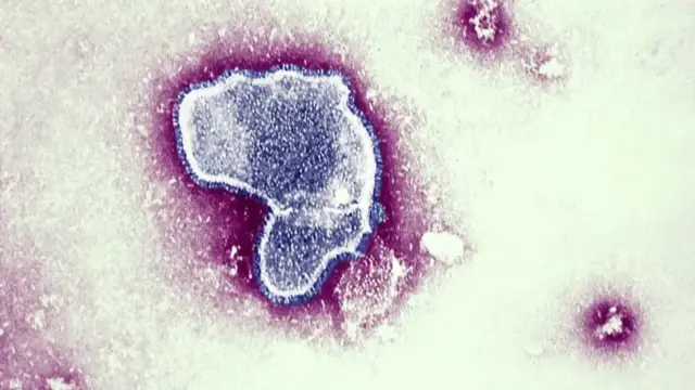 Identifican los tres primeros casos de bronquiolitis por una mutación del VRS que desafía al tratamiento que protege a los bebés